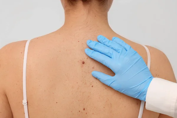 Dermatolog Vyšetřující Pacientovo Mateřské Znaménko Béžovém Pozadí Detailní Záběr — Stock fotografie