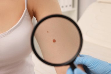 Dermatolog, hastanın doğum lekesini içeride büyüteçle inceliyor.