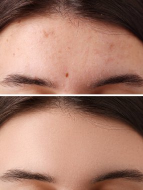 Tedavi öncesi ve sonrası sivilceli kadın fotoğraflarıyla kolaj, yakın plan