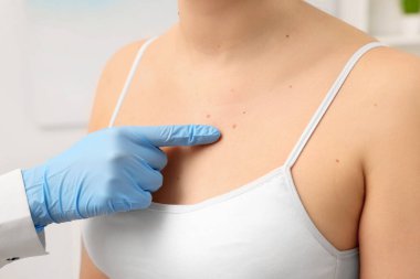 Dermatolog, hastanın doğum lekesini kapalı alanda inceliyor.