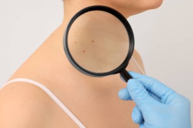 Dermatolog, hastanın doğum lekesini bej arka planda büyüteçle inceliyor.