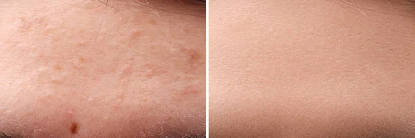 Collage Mit Fotos Von Frauen Mit Akne Problem Vor Und — Stockfoto