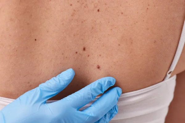 Dermatologist Rubber Glove Examining Patient Birthmark Closeup View — Stock Photo, Image