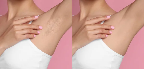 stock image Before and after epilation. Collage with photos of woman showing armpit on pink background, closeup