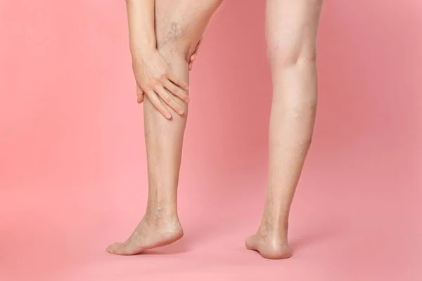 Closeup View Woman Suffering Varicose Veins Pink Background — Stock Photo, Image