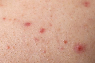 Sivilceli genç adam, cilde yakından bakıyor.