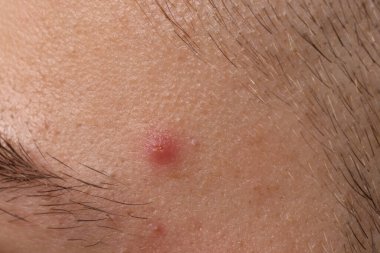 Sivilceli genç adam, yakından bak.