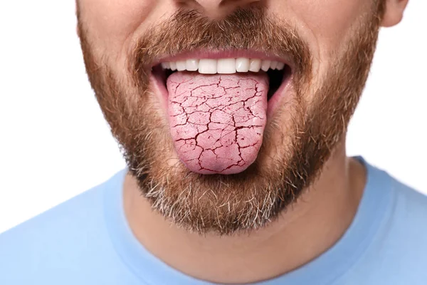 Mundtrockenheit Mann Zeigt Dehydrierte Zunge Auf Weißem Hintergrund Nahaufnahme — Stockfoto
