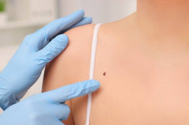 Dermatolog, hastanın doğum lekesini kapalı alanda inceliyor.