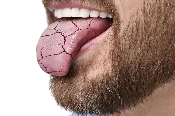 Objawy Suchości Ustach Mężczyzna Pokazuje Odwodniony Język Białym Tle Zbliżenie — Zdjęcie stockowe