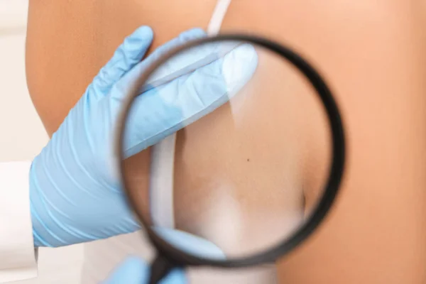 Dermatólogo Examinando Marca Nacimiento Del Paciente Con Lupa Primer Plano — Foto de Stock
