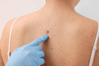 Lastik eldivenli bir cildiyeci hastanın doğum lekesini inceliyor.