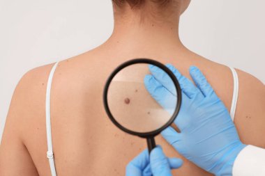 Dermatolog, hastanın doğum lekesini bej arka planda büyüteçle inceliyor.