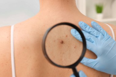 Dermatolog, hastanın doğum lekesini içeride büyüteçle inceliyor.