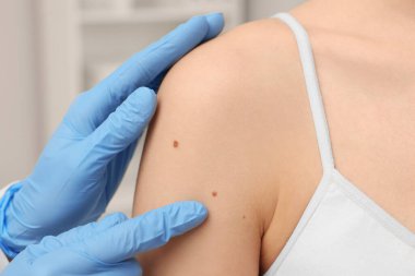 Dermatolog, hastanın doğum lekesini kapalı alanda inceliyor.