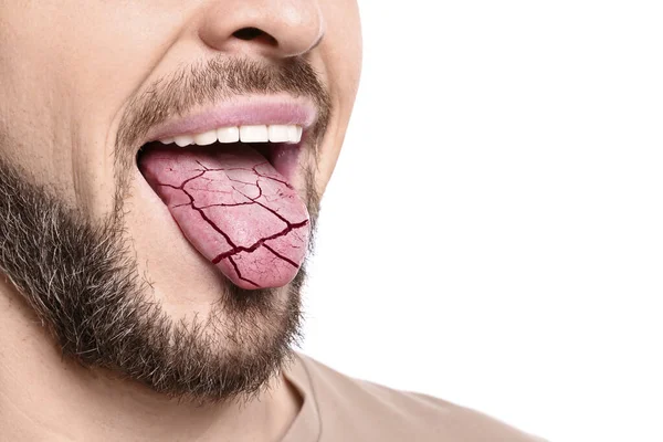 Gejala Keringkan Mulut Man Menunjukkan Lidah Dehidrasi Pada Latar Belakang — Stok Foto