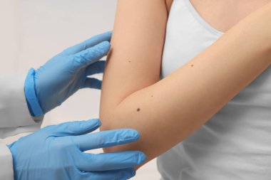 Dermatolog, hastanın doğum lekesini kapalı alanda inceliyor.