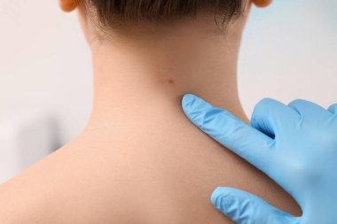 Dermatolog, bulanık arka planda hastanın doğum lekesini inceliyor.