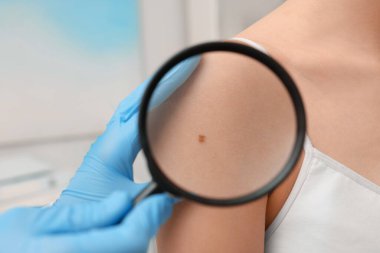 Dermatolog, hastanın doğum lekesini içeride büyüteçle inceliyor.