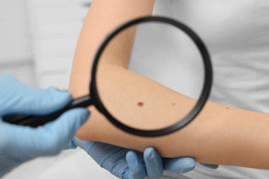 Dermatolog, hastanın doğum lekesini içeride büyüteçle inceliyor.