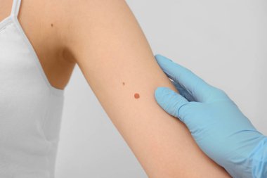 Dermatolog, hastanın doğum lekesini bej arka planda inceliyor.