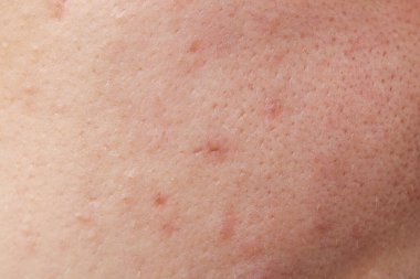 Yüzünde, closeup akne olan kadın