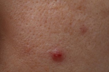 Yüzünde, closeup akne olan kadın