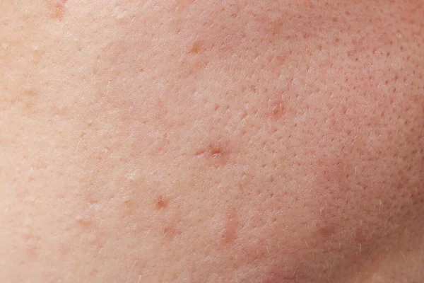 Young Woman Acne Her Face Closeup — Stock Photo, Image
