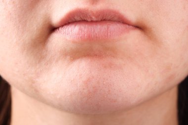 Sivilceli genç bir kadın, yakından bakıyor.