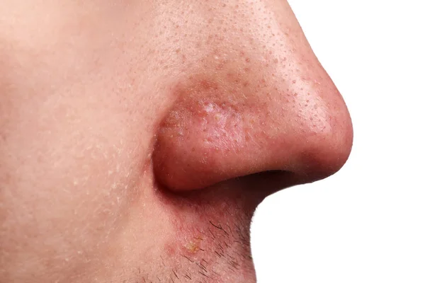 白い背景にアクネの問題を抱えている若者 鼻のクローズアップビュー — ストック写真