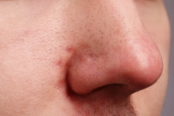 にきびの問題を抱えている若者 鼻のクローズアップビュー — ストック写真