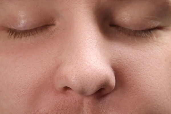 Młody Człowiek Trądzikiem Widok Bliska Nosa — Zdjęcie stockowe