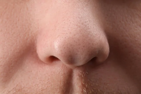 Young Man Acne Problem Closeup View Nose — Stock Photo, Image
