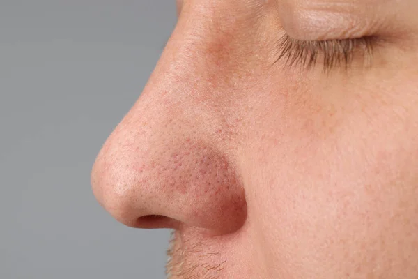 Junger Mann Mit Akne Problem Auf Grauem Hintergrund Nahaufnahme — Stockfoto
