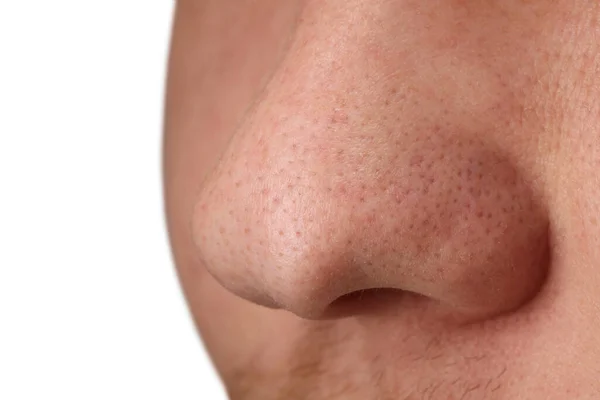 Junger Mann Mit Akne Problem Auf Weißem Hintergrund Nahaufnahme — Stockfoto
