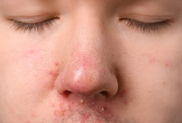 Junger Mann Mit Akne Problem Nahaufnahme — Stockfoto
