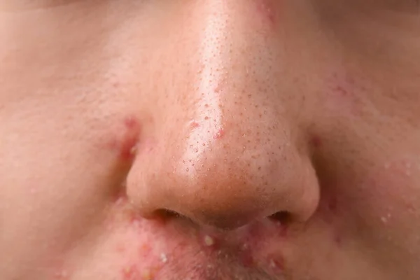 Junger Mann Mit Akne Problem Nahaufnahme Der Nase — Stockfoto