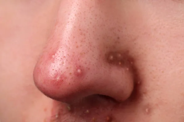にきびの問題を抱えている若者 鼻のクローズアップビュー — ストック写真