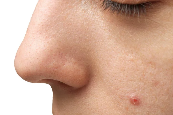 Young Woman Acne Problem White Background Closeup View Nose — Stock Photo, Image