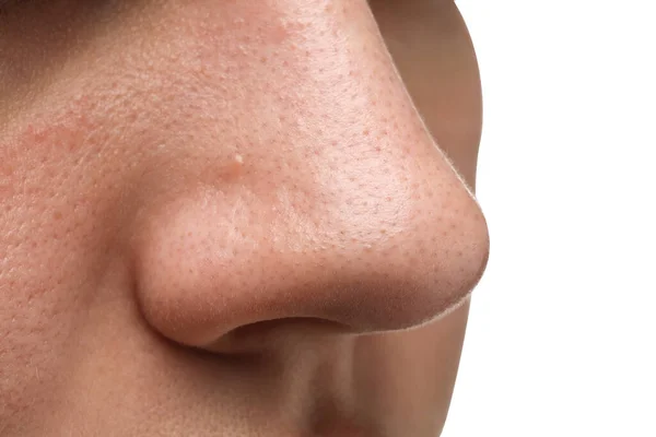 Młoda Kobieta Problemem Trądziku Białym Tle Widok Bliska Nosa — Zdjęcie stockowe