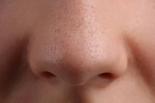 Młoda Kobieta Problemem Trądziku Zbliżenie Widok Nosa — Zdjęcie stockowe