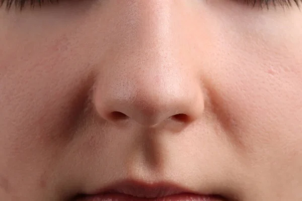 Young Woman Acne Problem Closeup View — Stock Photo, Image