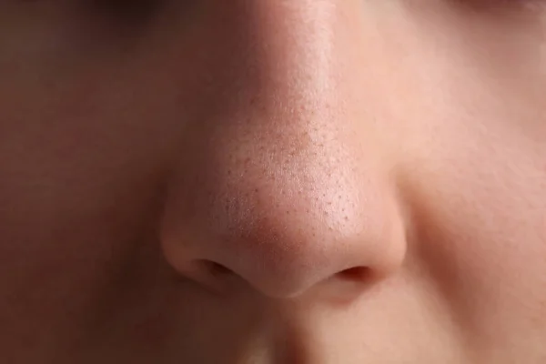 Wanita Muda Dengan Masalah Jerawat Pandangan Dekat Hidung — Stok Foto