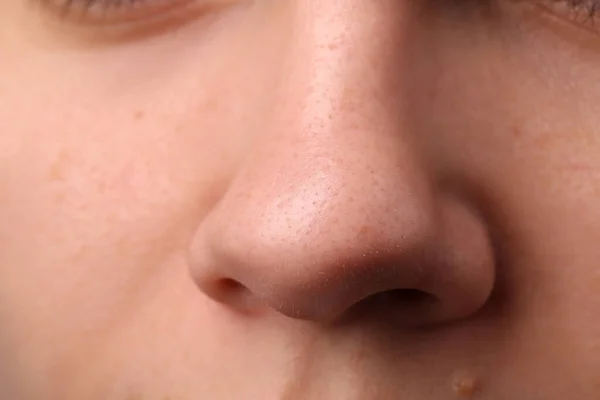 にきびの問題を抱えている若い女性 鼻のクローズアップビュー — ストック写真