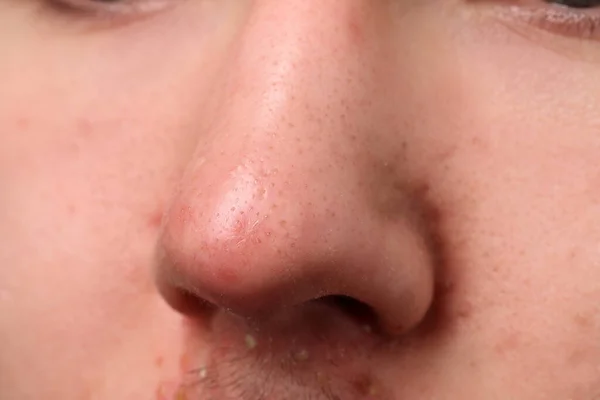 Mladý Muž Akné Problém Detailní Pohled Nos — Stock fotografie