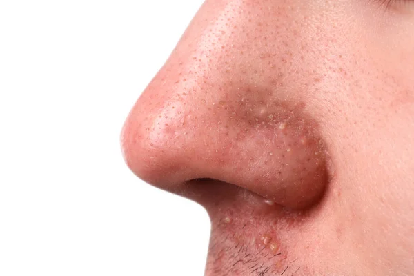 灰色の背景にアクネの問題を抱えている若者 鼻のクローズアップビュー — ストック写真