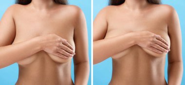Collage with photos of woman before and after breast-lift surgery on light blue background, closeup clipart