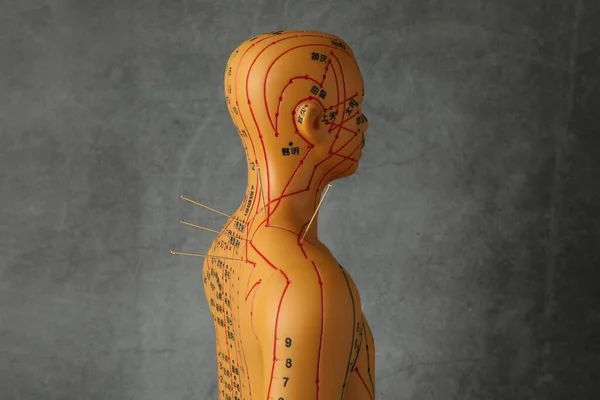 Acupuncture - alternative medicine. Human model with needles in shoulder against dark grey background