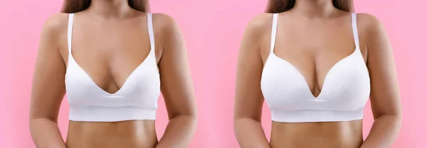 Woman Breast Augmentation Pink Background Closeup Collage Photos Showing Difference — Stock Photo, Image