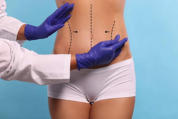 Doctor and patient preparing for cosmetic surgery, light blue background. Woman with markings on her abdomen, closeup